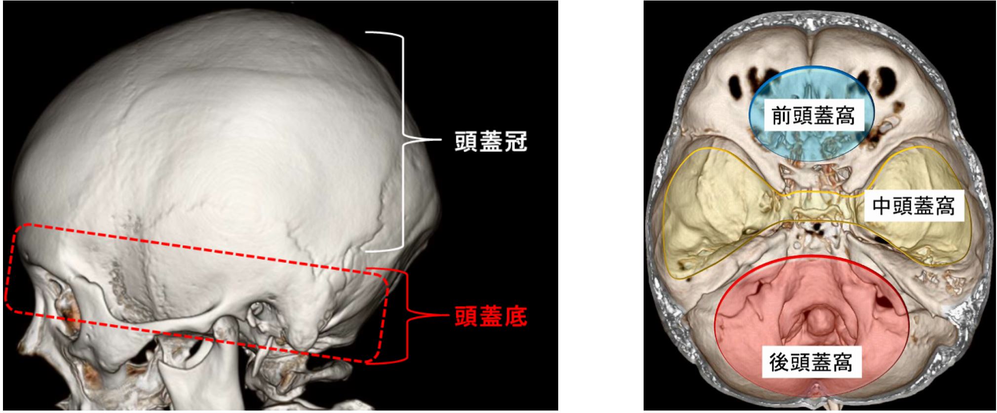 ビジュアル脳神経外科 5 前頭蓋窩・眼窩・中頭蓋窩 裁断済 - 健康/医学