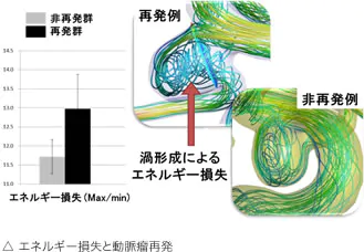 エネルギー損失と動脈瘤再発